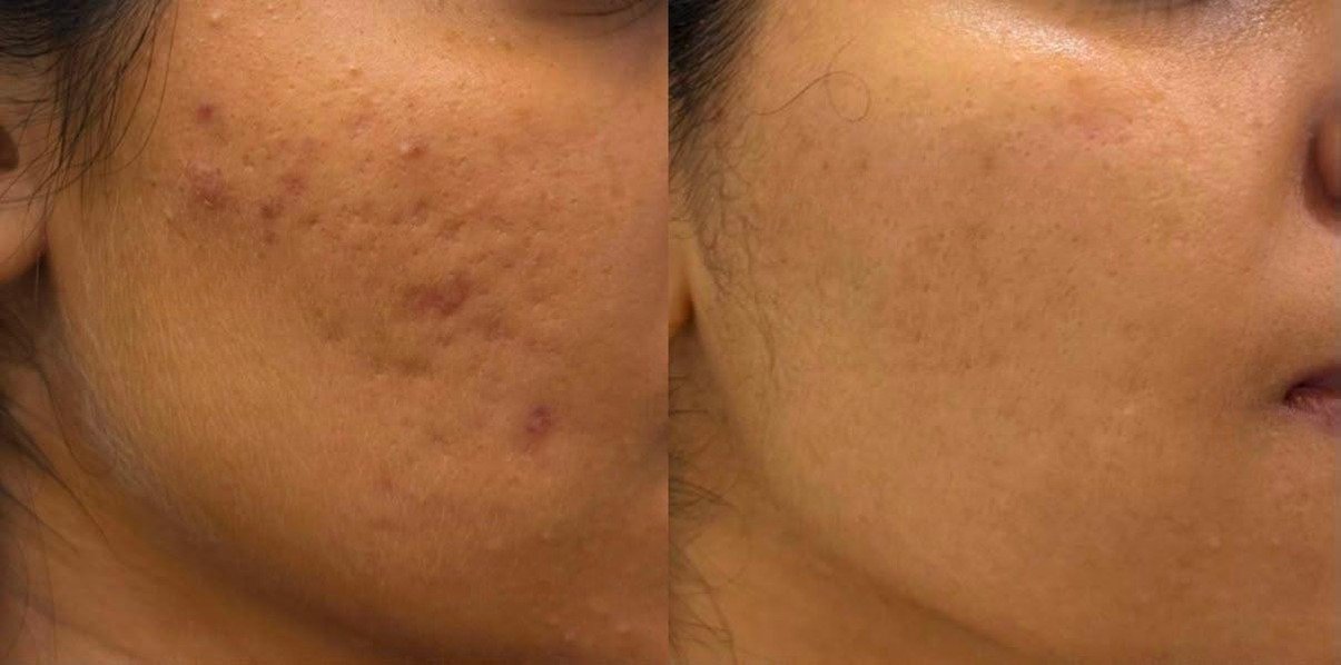 Acne-scar treatment before and after at Perfect 5 Clinic